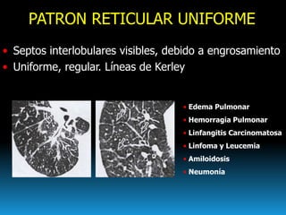 PATRON RETICULAR UNIFORME
• Septos interlobulares visibles, debido a engrosamiento
• Uniforme, regular. Líneas de Kerley
•...
