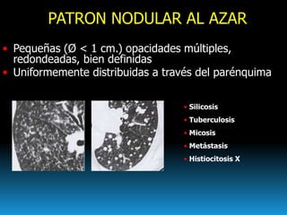PATRON NODULAR AL AZAR
• Pequeñas (Ø < 1 cm.) opacidades múltiples,
redondeadas, bien definidas
• Uniformemente distribuid...