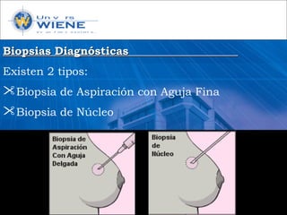 Biopsias DiagnósticasBiopsias Diagnósticas
Existen 2 tipos:
Biopsia de Aspiración con Aguja Fina
Biopsia de Núcleo
 