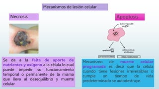 Mecanismos de lesión celular
Necrosis Apoptosis
Se da a la falta de aporte de
nutrientes y oxígeno a la célula lo cual
puede impedir su funcionamiento
temporal o permanente de la misma
que lleva al desequilibrio y muerte
celular
Mecanismo de muerte celular
programada es decir que la célula
cuando tiene lesiones irreversibles o
cumple un tiempo de vida
predeterminado se autodestruye.
 