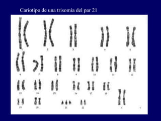 Cariotipo de una trisomía del par 21
 