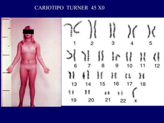 CARIOTIPO TURNER 45 X0
 