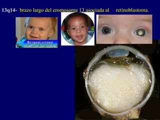 13q14- brazo largo del cromosoma 13 asociada al retinoblastoma.
 