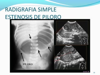 RADIGRAFIA SIMPLE
ESTENOSIS DE PILORO
30
 