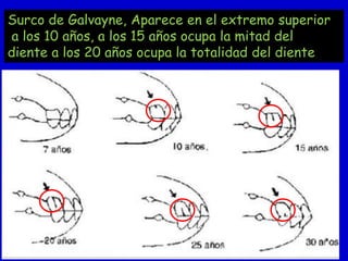 Surco de Galvayne, Aparece en el extremo superior
a los 10 años, a los 15 años ocupa la mitad del
diente a los 20 años ocupa la totalidad del diente

 