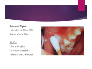 Anestesia Tópica
Lidocaína al 5% o 20%
Benzocaína al 20%
PASOS:
- Secar el tejido
- Colocar anestésico
- Deje actuar 2 minutos
 