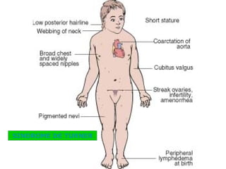 SINDROME DE TURNER 