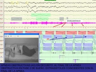 APNEAS OBSTRUCTIVAS (AO) EN DECUBITO ,AL FINAL DE LA APNEA OBSTRUCTIVA EN FASE 2 DE SUEÑO. EXTRASISTOLES COINCIDENTES CON EL FINAL DE LA APNEA. EXTRASISTOLES AO 