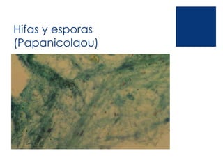 Hifas y esporas
(Papanicolaou)
 