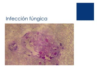 Infección fúngica
 