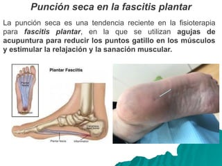 Punción seca en la fascitis plantar
La punción seca es una tendencia reciente en la fisioterapia
para fascitis plantar, en la que se utilizan agujas de
acupuntura para reducir los puntos gatillo en los músculos
y estimular la relajación y la sanación muscular.
 