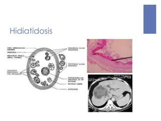 Hidiatidosis
 