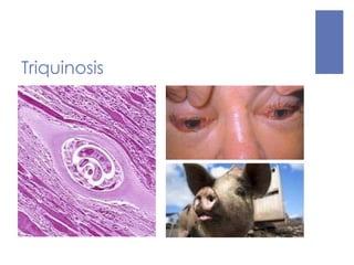 Triquinosis
 