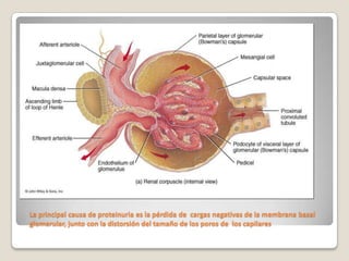 La principal causa de proteinuria es la pérdida de cargas negativas de la membrana basal
glomerular, junto con la distorsión del tamaño de los poros de los capilares
 