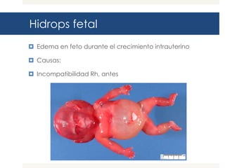 Hidrops fetal
 Edema en feto durante el crecimiento intrauterino
 Causas:
 Incompatibilidad Rh, antes

 