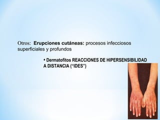 Otros:Otros: Erupciones cutáneas: procesos infecciosos
superficiales y profundos
• Dermatofitos REACCIONES DE HIPERSENSIBILIDAD
A DISTANCIA (“IDES”)
 