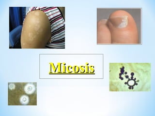 MicosisMicosis
 