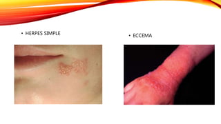 • HERPES SIMPLE • ECCEMA
 
