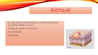 PÚSTULAS
- Es una lesión sobreelevada con contenido líquido
purulento desde su inicio
- Puede ser estéril o infeccioso
- No foliculares
- foliculares
 