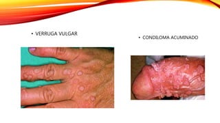 • VERRUGA VULGAR
• CONDILOMA ACUMINADO
 