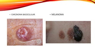 • CARCINOMA BASOCELULAR • MELANOMA
 