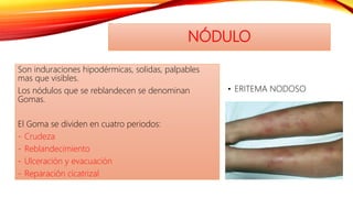NÓDULO
Son induraciones hipodérmicas, solidas, palpables
mas que visibles.
Los nódulos que se reblandecen se denominan
Gomas.
El Goma se dividen en cuatro periodos:
- Crudeza
- Reblandecimiento
- Ulceración y evacuación
- Reparación cicatrizal
• ERITEMA NODOSO
 
