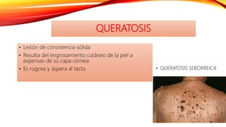 QUERATOSIS
• Lesión de consistencia sólida
• Resulta del engrosamiento cutáneo de la piel a
expensas de su capa córnea
• Es rugosa y áspera al tacto • QUERATOSIS SEBORREICA
 