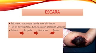 ESCARA
• Tejido necrosado que tiende a ser eliminado
• Piel es desvitalizada, dura, seca con alteración vascular
• Eritema Ampolla ulceración Escara
 