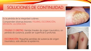 SOLUCIONES DE CONTINUIDAD
Es la pérdida de la integridad cutánea.
Comprenden diversas lesiones: FISURAS, ESCORIACIÓN,
EROSIÓN, ULCERACIÓN
- FISURAS O GRIETAS: Heridas lineales de origen traumático, sin
perdida de sustancia, puede ser superficial o profunda.
- ESCORIACIÓN: Pequeñas perdidas de sustancia de origen
traumático, solo afectan la epidermis.
 