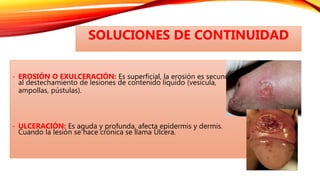 - EROSIÓN O EXULCERACIÓN: Es superficial, la erosión es secundaria
al destechamiento de lesiones de contenido liquido (vesícula,
ampollas, pústulas).
- ULCERACIÓN: Es aguda y profunda, afecta epidermis y dermis.
Cuando la lesión se hace crónica se llama Úlcera.
SOLUCIONES DE CONTINUIDAD
 