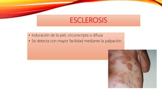 ESCLEROSIS
• Induración de la piel, circunscripta o difusa
• Se detecta con mayor facilidad mediante la palpación.
 