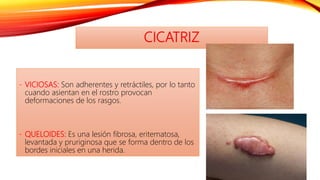 - VICIOSAS: Son adherentes y retráctiles, por lo tanto
cuando asientan en el rostro provocan
deformaciones de los rasgos.
- QUELOIDES: Es una lesión fibrosa, eritematosa,
levantada y pruriginosa que se forma dentro de los
bordes iniciales en una herida.
CICATRIZ
 