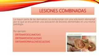 LESIONES COMBINADAS
La mayor parte de las dermatosis no evolucionan con una sola lesión elemental
por lo que se encuentran una asociación de lesiones elementales en una misma
patología.
Por ejemplo:
- ERITEMATOESCAMOSAS
- ERITEMATOVESICULOSAS
- ERITEMATOPAPULOVESICULOSAS
 