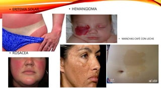 • ROSACEA
• ERITEMA SOLAR • HEMANGIOMA
• MANCHAS CAFÉ CON LECHE
 