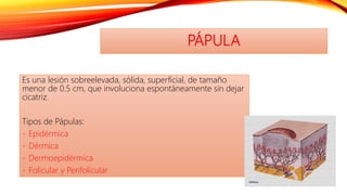 PÁPULA
Es una lesión sobreelevada, sólida, superficial, de tamaño
menor de 0.5 cm, que involuciona espontáneamente sin dejar
cicatriz.
Tipos de Pápulas:
- Epidérmica
- Dérmica
- Dermoepidérmica
- Folicular y Perifolicular
 