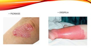 • ERISIPELA
• PSORIASIS
 