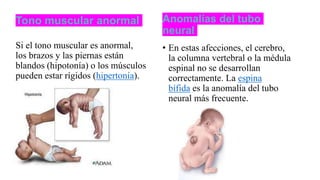 Tono muscular anormal
Si el tono muscular es anormal,
los brazos y las piernas están
blandos (hipotonía) o los músculos
pueden estar rígidos (hipertonía).
Anomalías del tubo
neural
• En estas afecciones, el cerebro,
la columna vertebral o la médula
espinal no se desarrollan
correctamente. La espina
bífida es la anomalía del tubo
neural más frecuente.
 