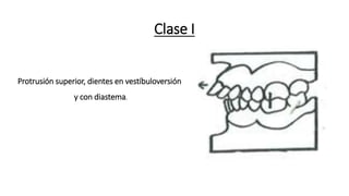 Clase I
Protrusión superior, dientes en vestíbuloversión
y con diastema.
 
