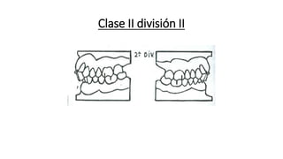 Clase II división II
 