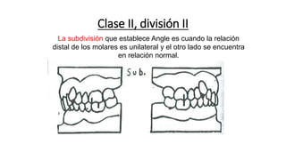 Clase II, división II
La subdivisión que establece Angle es cuando la relación
distal de los molares es unilateral y el otro lado se encuentra
en relación normal.
 