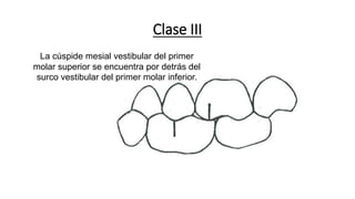 Clase III
La cúspide mesial vestibular del primer
molar superior se encuentra por detrás del
surco vestibular del primer molar inferior.
 