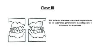 Clase III
Los incisivos inferiores se encuentran por delante
de los superiores, generalmente tapando parcial o
totalmente los superiores.
 