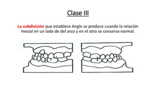 Clase III
La subdivisión que establece Angle se produce cuando la relación
mesial en un lado de del arco y en el otro se conserva normal.
 