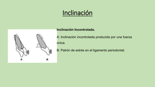 Inclinación
Inclinación Incontrolada.
A: Inclinación incontrolada producida por una fuerza
única.
B: Patrón de estrés en el ligamento periodontal.
 