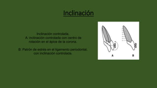 Inclinación
Inclinación controlada.
A: inclinación controlada con centro de
rotación en el ápice de la corona.
B: Patrón de estrés en el ligamento periodontal,
con inclinación controlada.
 