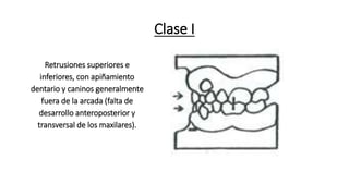 Clase I
Retrusiones superiores e
inferiores, con apiñamiento
dentario y caninos generalmente
fuera de la arcada (falta de
desarrollo anteroposterior y
transversal de los maxilares).
 