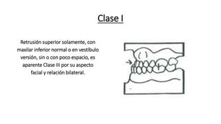 Clase I
Retrusión superior solamente, con
maxilar inferior normal o en vestíbulo
versión, sin o con poco espacio, es
aparente Clase III por su aspecto
facial y relación bilateral.
 