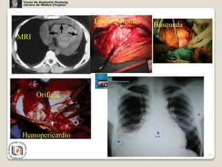 18
Epicardiotomía
MRI
Búsqueda
Orificio
Hemopericardio
“Curso de Anatomía Humana:
carrera de Médico Cirujano”
 