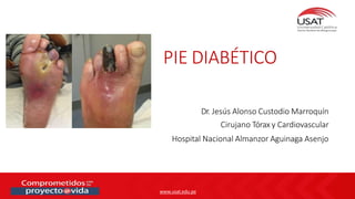www.usat.edu.pe
Dr. Jesús Alonso Custodio Marroquín
Cirujano Tórax y Cardiovascular
Hospital Nacional Almanzor Aguinaga Asenjo
PIE DIABÉTICO
 