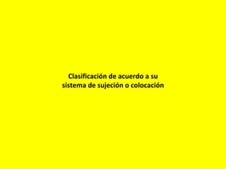 Clasificación de acuerdo a su
sistema de sujeción o colocación
 